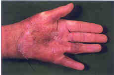 Fig. 4Prolonged exposure to 80 �C water during an epileptic fit led to damage of the deep layers in the subcutaneous layer. Healing is prolonged, complicated, oedema persists despite compressive therapy, which prevents rehabilitation of minor joints of the hand.
