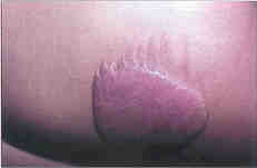 Fig. 5The same reaction as after a burn can be observed at a donor site. After passing a certain limit when taking a skin graft, hypertrophy of the scar may develop while the more superficial borders do not hypertrophy. We think that in both instances the cause of an excessive reduction in the firmness of the skin at the donor site of the graft is an excessive reparative response of the organism.