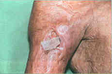 Fig. 6aOlder hypertrophic scars necrotize as a result of ischaemisation; they disintegrate and frequently become infected. In the picture: an abscess in the scar with a capillary drain.