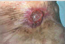 Fig. 6bRepeated disintegrations of hypertrophic scars lead to chronic irritation, which may undergo malignant reversal. In the picture: a carcinoma in the scar after scalding of the skin 50 years previously.