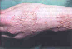 Fig. 9aUnprofessionally performed autotransplantation of area IIb with a very thick graft, which morover has a coarse network on a visible part of the body. The patient attended the Burns Clinic for a reparative operation: the whole graft was removed and the area was evened out.