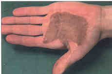 Fig. 9bMarkedly hyperpigmented autograft, taken in the groin and inserted after excision and release of scars on the palm. If such a transplant is placed in the face, it is frequently more striking than the scar which it replaces.