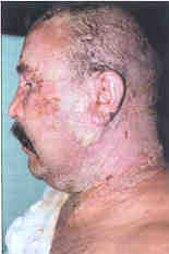 Fig. 10Unsuitably treated superficial burn that is easily infected and subsequently deepens. It is useful to remove fibrin bullae by the 3rd-5th day after a burn and cover the areas by another suitable cover. Fibrin beneath the bulae is a cultivation medium for saprophytes in the adnexa and aerogenic infection - most frequently Staphylococcus pyogenes - aureus.