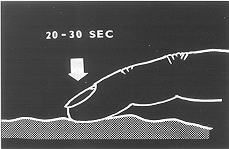 Fig. 15Pressure massage is implemented at selected sites by the finger tip for a period of 30 s; then we shift to the neighbouring tough spot. In extensive areas it is necessary to combine this massage with an elastic compressive aids.