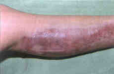 Fig. 19Result of mild experimental compression by a combination of Medigel and an elastic slip-on. At the site of application of the gel plate, the oedema is markedly reduced and the scar improved. After this experience the whole scar was treated in the same fashion.