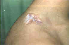 Fig. 20Minor hypertrophic scars can be treated by the administration of Kenalog. Under local anesthesia the preparation is administered closely beneath the epithelium and a depot is created. The latter is left in place till the scars dissolve in it, then the remnants of the white sediment are removed. The marked vascular pattern in the scar and surroundings is a sign of the activity and effective action of the preparation. The scar is checked regularly at 3-week intervals.