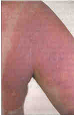 Fig. 21Inadequately lubricated spontaneously epithelized grade IIb burns on the back itch considerably, are scaly and the oedema persists for a long time before preserved skin adnexa start