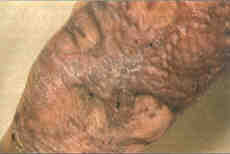 Fig. 22Lubrication in healed and epithelized granulation areas in the vicinity of grafts is particularly important.Adnexa are not present here and practically never regenerate. If the area is not properly lubricated, it becomes too dry and the surface desquamates. Beneath the scales rhagads are formed that may become secondarily infected and result in the disintegration of the scar.