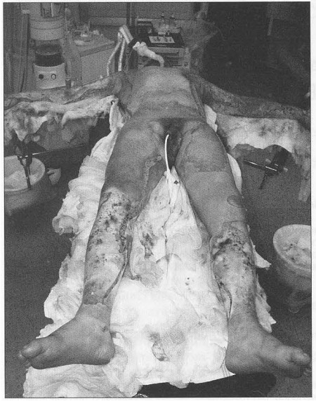 Fig. 1Burn wound dressed in the operation theatre.