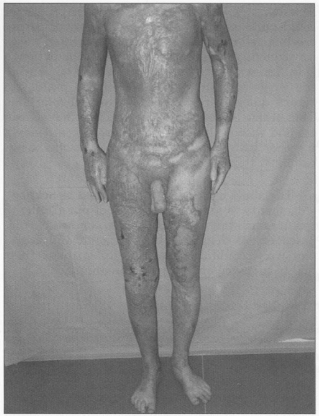 Fig. 2Taken shin Graft.