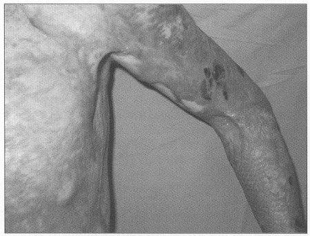 Fig. 3Reconstructed contractures in axilla region.