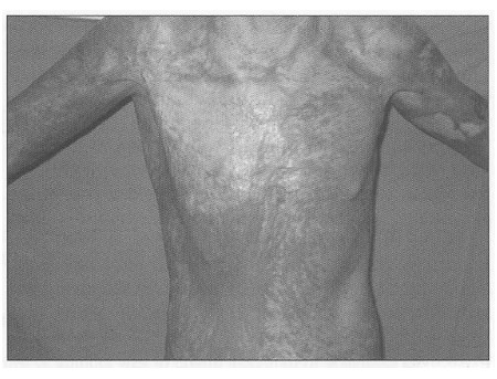 Fig. 4Reconstructed contractures in axilla region.