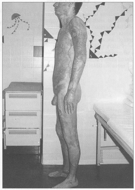 Fig. 5Taken skin graft.