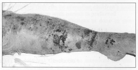 Fig. 1Lnwnrextremoty-Pemphig-usvulgaria, admission finding