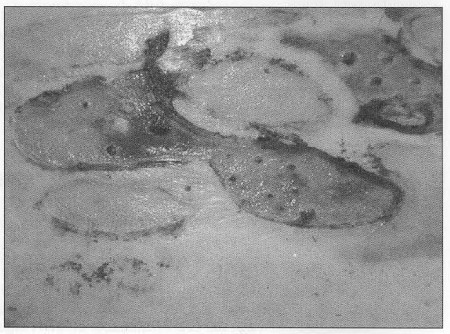 Fig. 2Pemphigus Vulgaris - detail of skin
