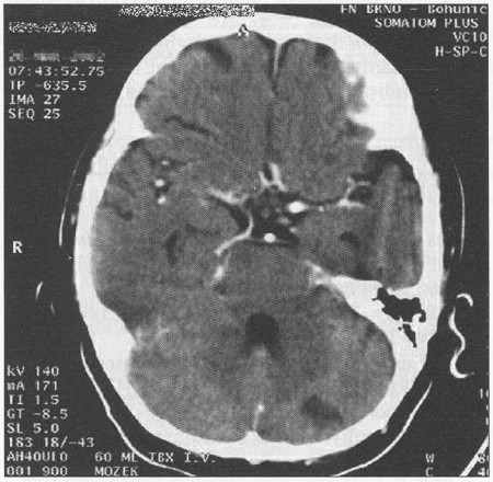 Fig. 3CT scan of the brain