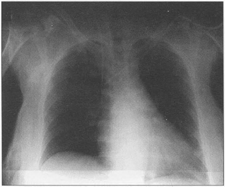 Fig. 4X-rays to heart and lungs