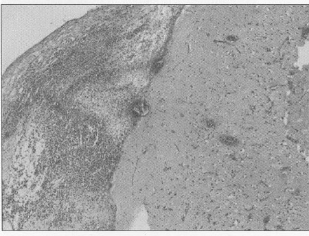 Fig. 6Lungs - autopsy