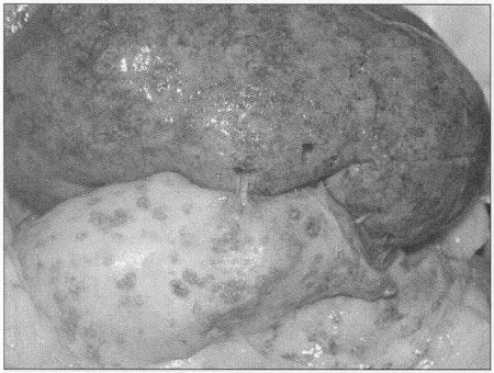 Fig. 8Kidney-autopsy