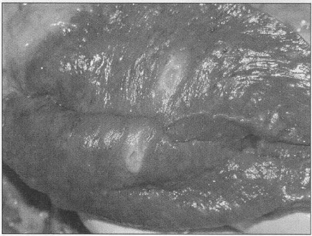 Fig. 10Myocardium - autopsy