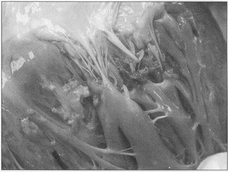 Fig. 11Endocardium - autopsy