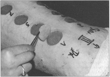Fig. 4Rebandage and monitoring bacterial infection.