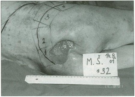 Fig. 7The view of sacral ulcer. The .scheme of application of interactive dressings.