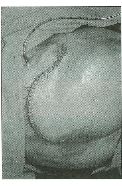 Fig. 9Surgical procedure, clore of defect by nmsculocutanc ue flap (glut. max.)