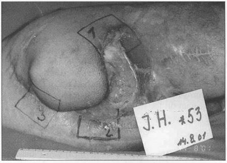 Fig. 10The vie„ of yressure.sore-largetrochantericulcer