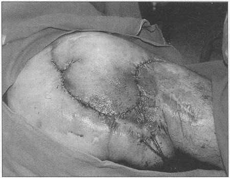 Fig. 12Surgical procedure-closure of the defect by muscu locutaneusflap