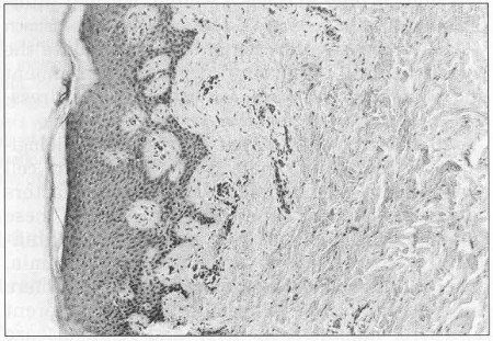 Fig. 14HE staining ~magruYicaiion 16x) Human intact skin submerged in Ringer solution for seventy-two hours (a positive control of maceration). Papillxr layer of decade, stratumbasale, stratum spino.sum contains cells with clear vacuoles m cytuplaem. Stratum disjunctum on the surface