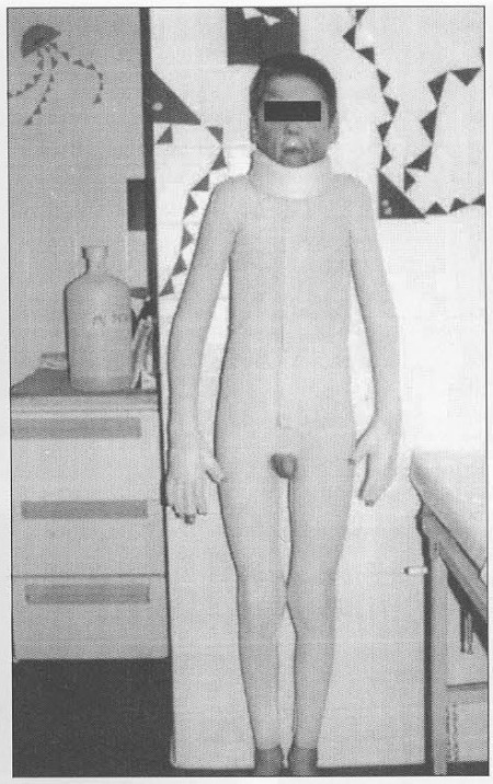 Fig. 1Patient 1. - elastic pressure garment with foam collar