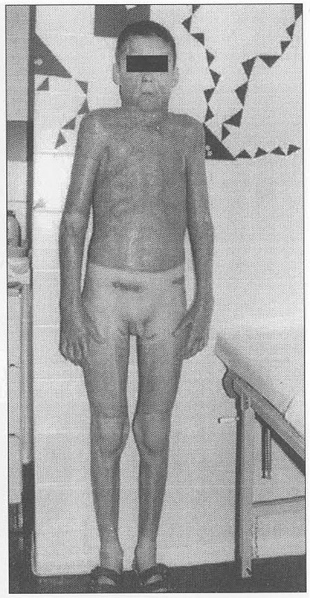 Fig. 2Patient 1. - neck contracture 2<sup>nd</sup> month after burn healing.