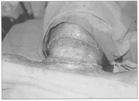 Fig. 3Patient 1. - use of medium thickness D-E graft after release of neck contracture.