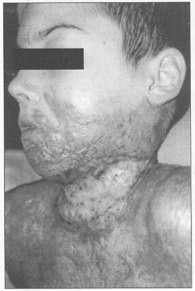 Fig. 4Patient 2. - healed graft and eliminatiopn of contracture.