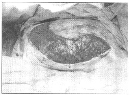 Fig. 5Patient 2. - mobilization of local skin graft on the lateral side of chest and abdomen.