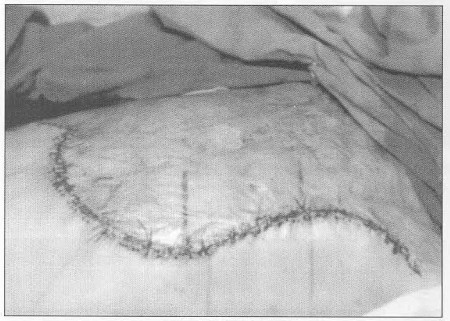 Fig. 6Patient 2. - status post skin graft shift to the secondary defect.