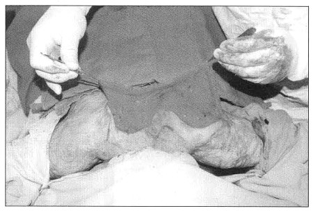 Fig. 7Patient 3. - mobilization of skin graft in the area between scapulae and on the left shoulder.