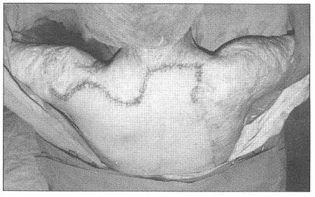Fig. 8Patient 3. - status post excision of scarred tissue and local shift of the skin graft.