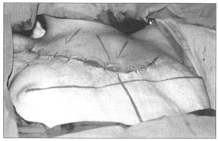 Fig. 10Patient 4. - status post expansion of the tissue.