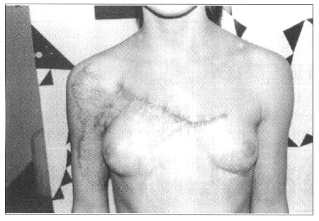 Fig. 11Patient 4. - healed wound.