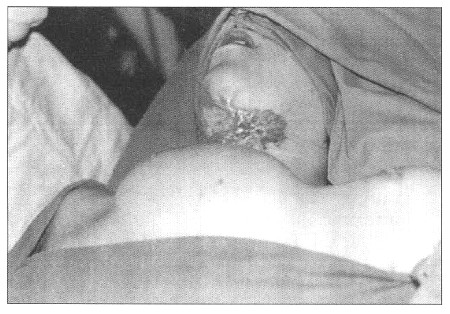 Fig. 12Patient 5. - implanted and filled tissue expander in the area above sternum and between clavicles.