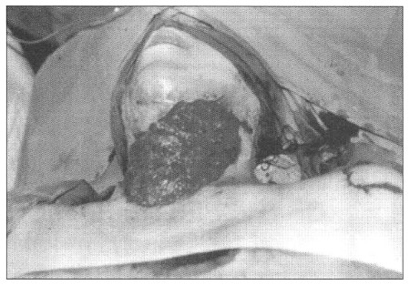 Fig. 13Patient 5. - excision of hypertrophic scar on neck and expanded skin graft before opening.