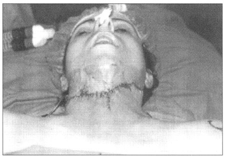 Fig. 14Patient 5. - statuas post expansion of skin graft.