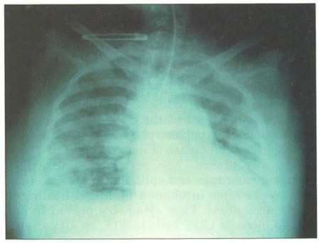 Fig. 1Skiagraphic correlation of ARDS