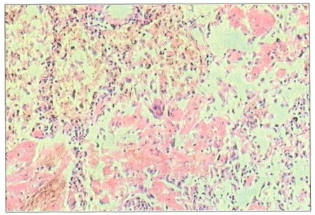Fig. 2Granulation tissue and hyaline substance in pulmonary alveoli, counter-stain HE, magnification 400x