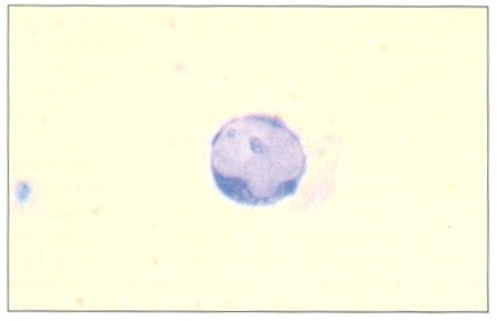 Fig. 3 bMonocyte with compact nucleolus, counterstain MGG and cytochemical stain of RNA and nucleols, magnification 1000x