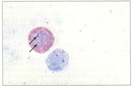 Fig. 4 bLymphocyte and eosinophile metamyelocyte with a compact and annular nucleol (marked by arrows), cytochemical stain of RNA and nucleols, magnification 1000x
