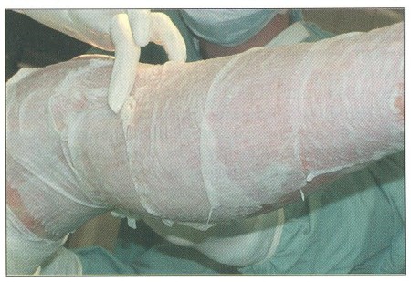 Fig. 4Porcine xenografts are used to corer clean superficial burns. Their application is r-atheu easy and they adhere well to wound bed