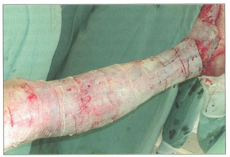 Fig. 5Porcine xenografts are used to cover raw meal after necrectomy
